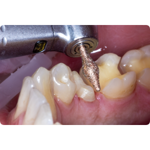 KP6370-Алмазные боры с керамическими жемчужинами DIAO Komet Dental (Комет Дентал)