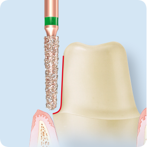 KP6856-Алмазные боры с керамическими жемчужинами DIAO Komet Dental (Комет Дентал)