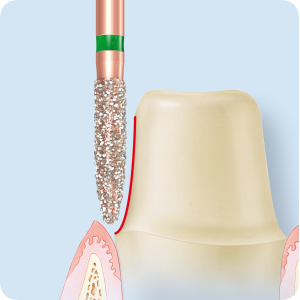 KP6862-Алмазные боры с керамическими жемчужинами DIAO Komet Dental (Комет Дентал)
