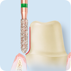 KP6879-Алмазные боры с керамическими жемчужинами DIAO Komet Dental (Комет Дентал)