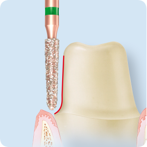 KP6878K-Алмазные боры с керамическими жемчужинами DIAO Komet Dental (Комет Дентал)