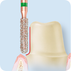 KP6880-Алмазные боры с керамическими жемчужинами DIAO Komet Dental (Комет Дентал)